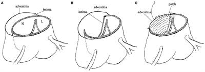 Perioperative and Short-Term Outcomes of Sinus Replacement and Conservative Repair for Aortic Root in Acute Type A Aortic Dissection: A Prospective Cohort Study